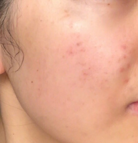 益膚醫(yī)用冷敷貼面膜怎么樣好不好，真實使用體驗(敏感肌必備)